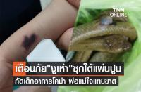 2歳の子供、毒蛇に手首を噛まれ重傷